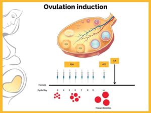 Ovulation Induction