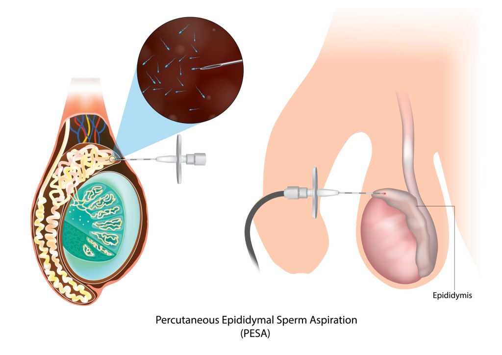 Testicular Sperm Aspiration (TESA), and Percutaneous Epididymal Sperm Aspiration (PESA), for sperm retrieval in azoospermia men.