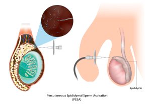 Testicular Sperm Aspiration (TESA), and Percutaneous Epididymal Sperm Aspiration (PESA), for sperm retrieval in azoospermia men.